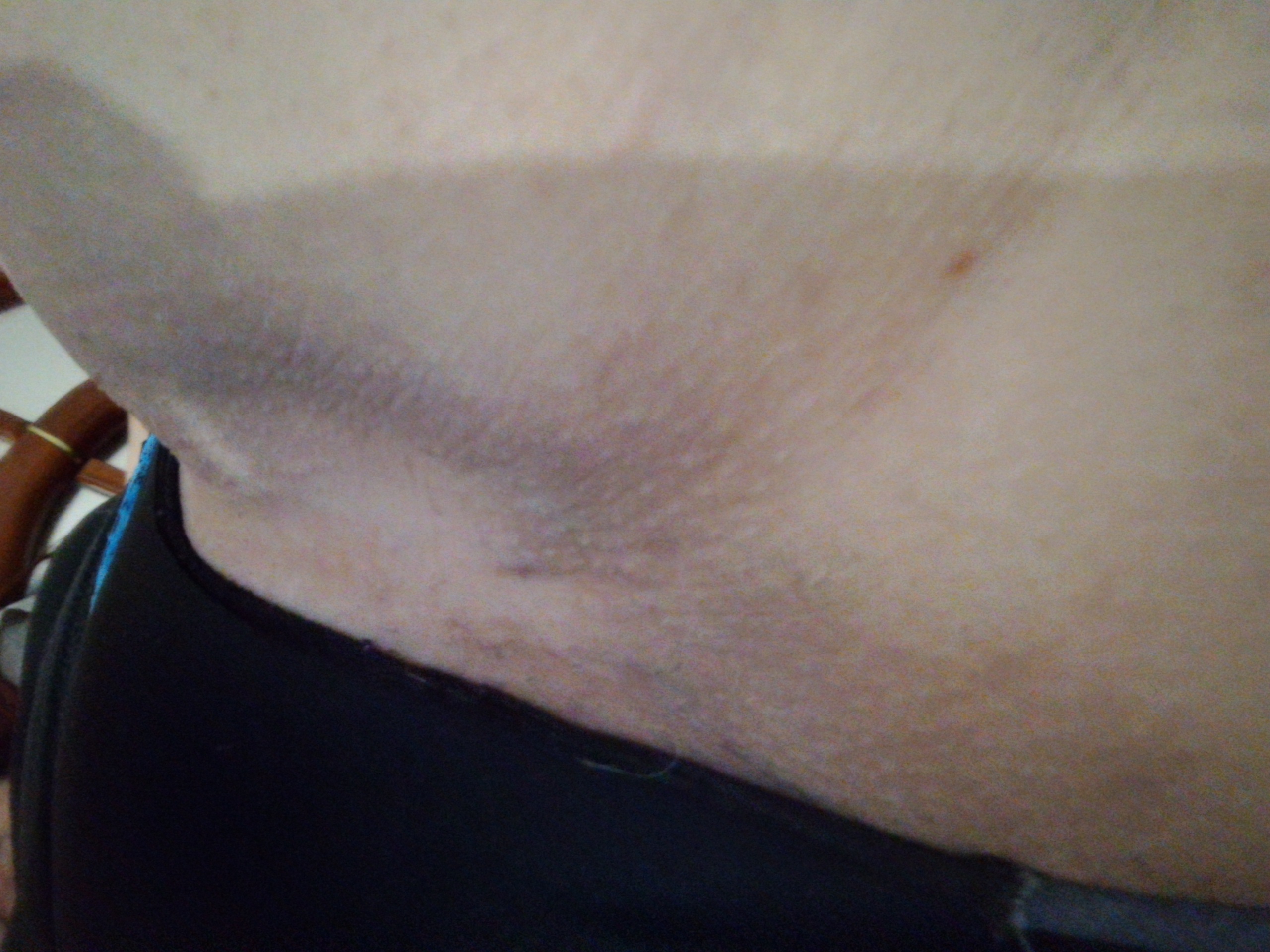 Resultado Tend Skin em 30 dias — foliculite eliminada e pele regenerada